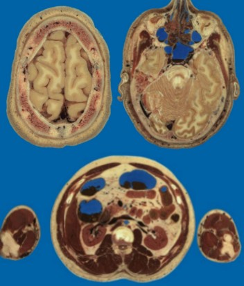 CAVIDADES-MRI