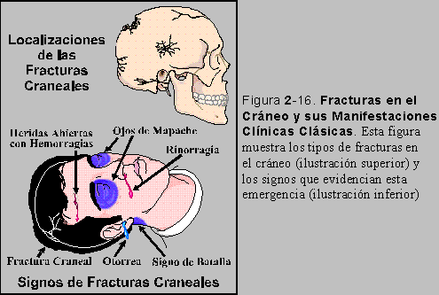 Figura 2-16: Fracturas en el Cráneo y sus Manifestaciones Clínicas