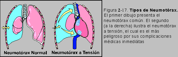 Figura 2-17: Tipos de Neumotórax