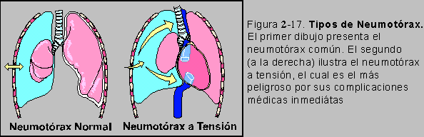 Figura 2-17: Tipos de Neumotrax