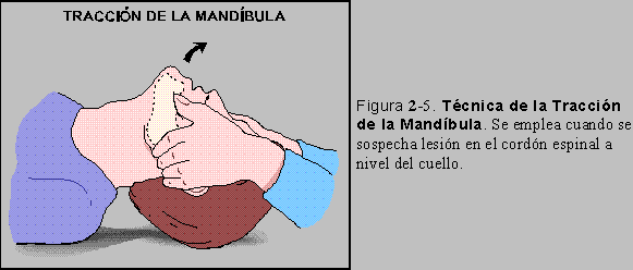 Figura 2-5: Tcnica de la Traccin de la Mandbula