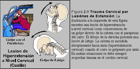 Figura 2-9: Trauma Cervical por Lesiones de Extensin